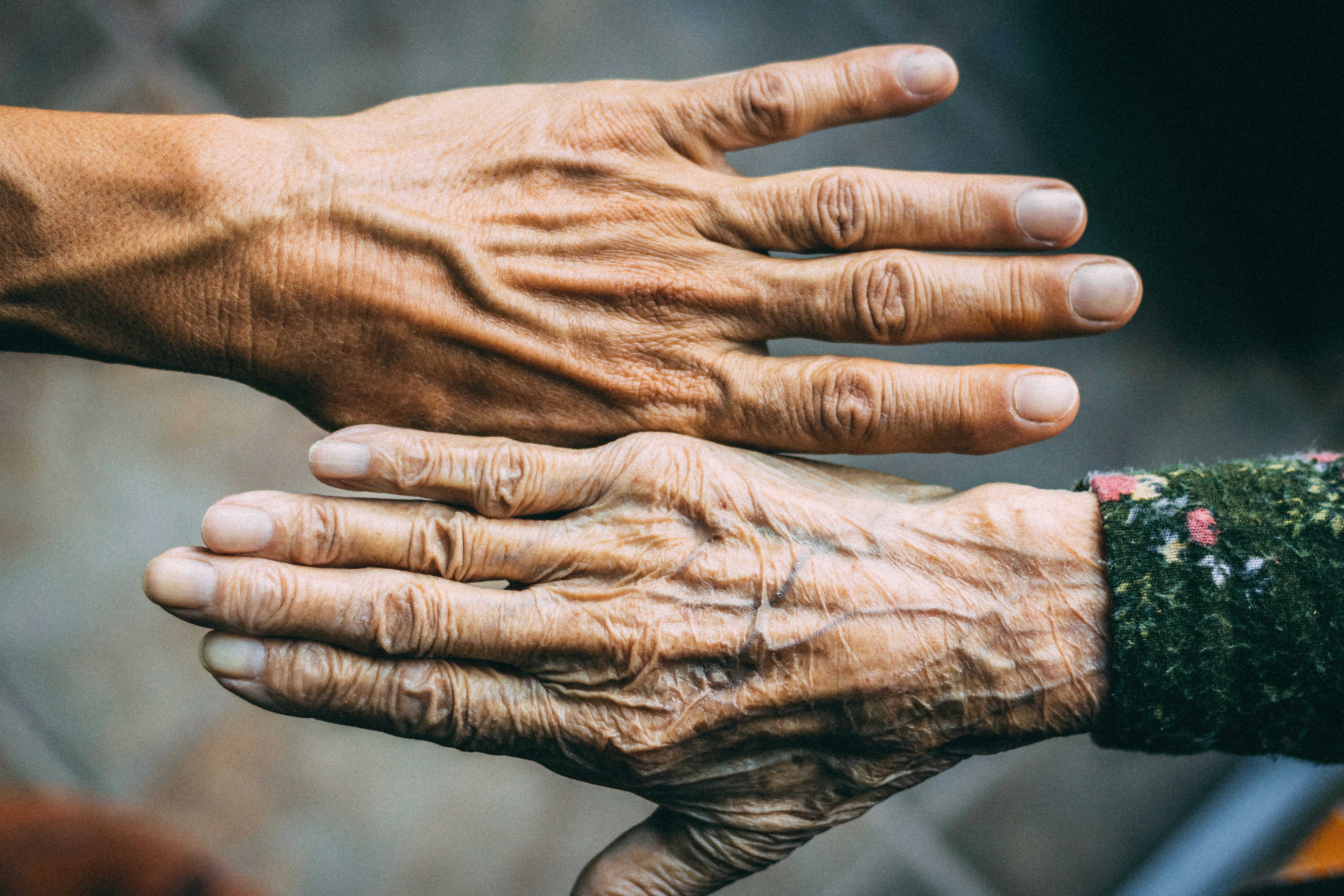 Osteoarthritis vs. Rheumatoid Arthritis